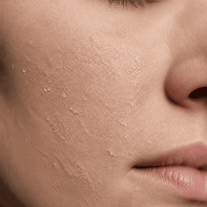 Dry & Dehydrated Skin