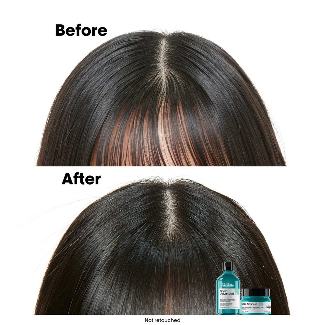 LOréal Scalp Advanced Shampoo for Anti-Oiliness 300ml