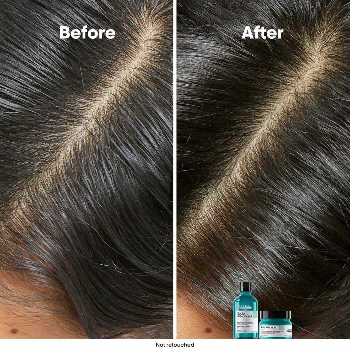 LOréal Scalp Advanced Shampoo for Anti-Oiliness 300ml