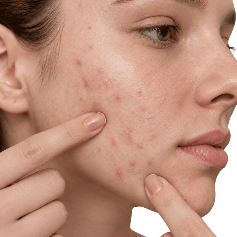 Acne & Breakouts